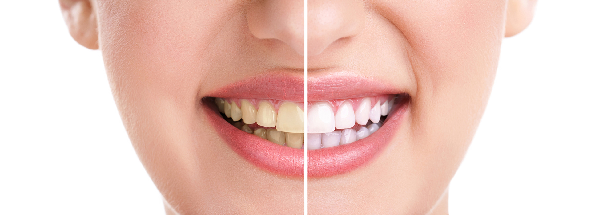 Teeth Whitening Plainfield